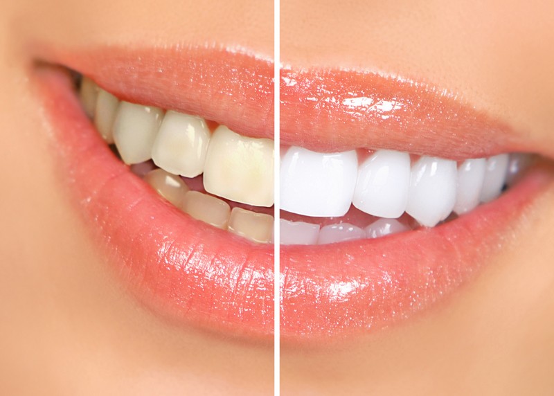 Teeth Whitening  Portland, ME